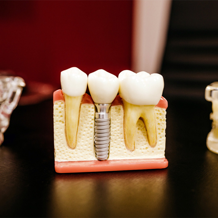 Dental Implants Lakeshore, Ontario, Canada- Emeryville Family Dental